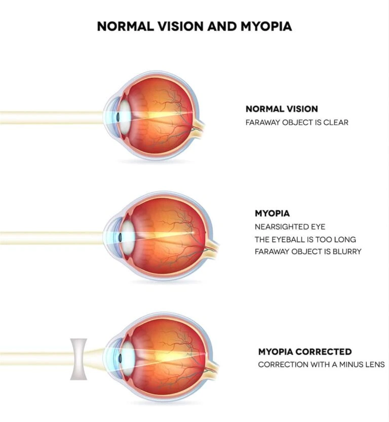 normal vision myopia chart